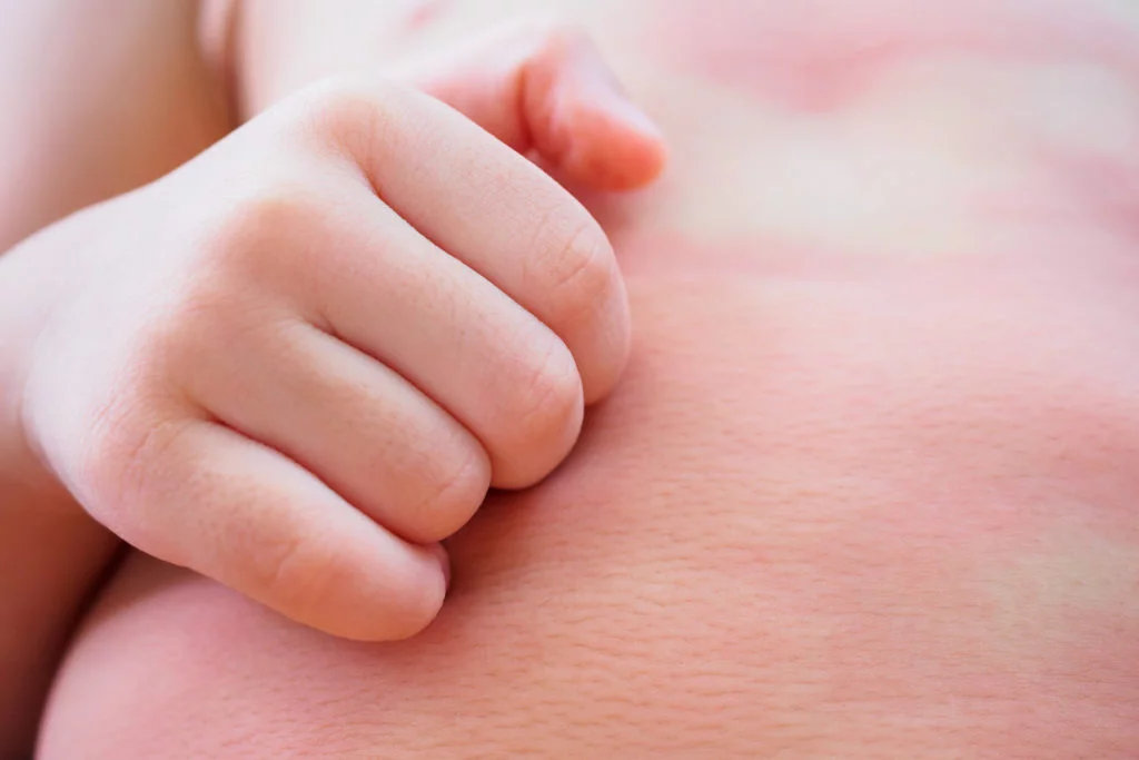 alergia niños salud