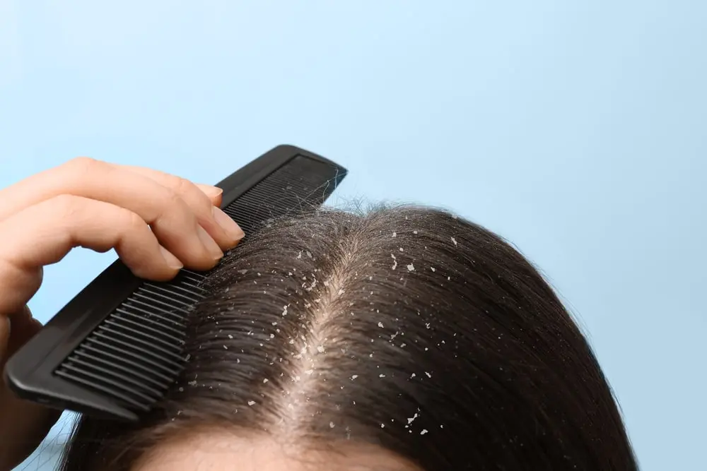caspa pelo cabello