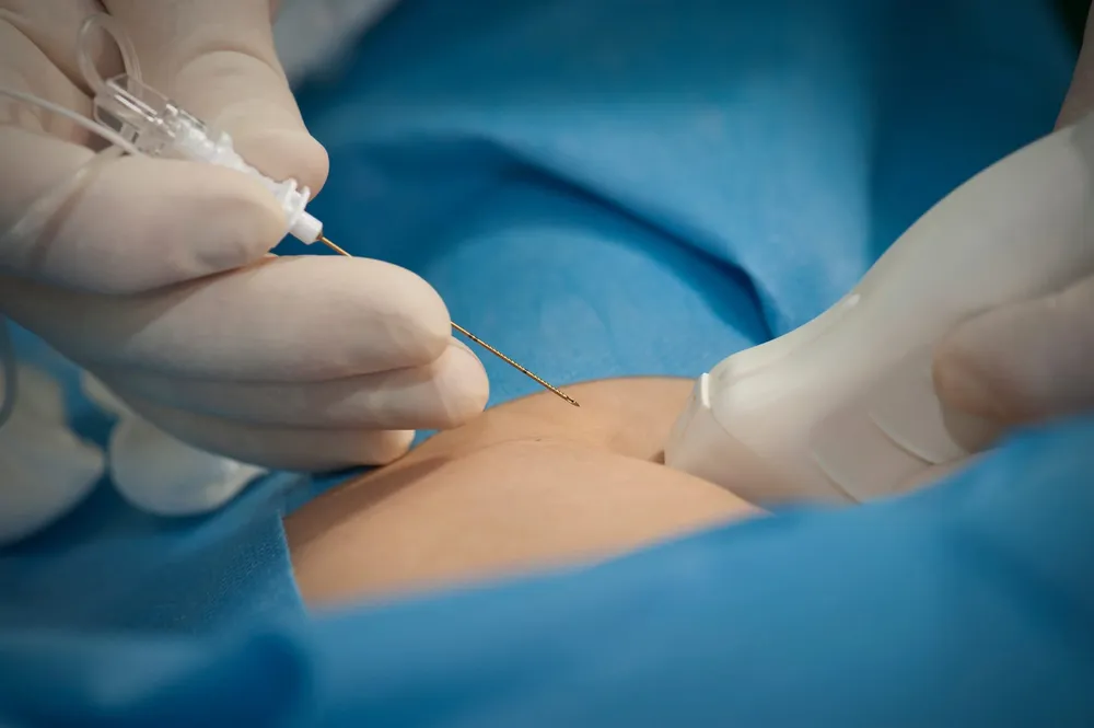 anestesia-epidural