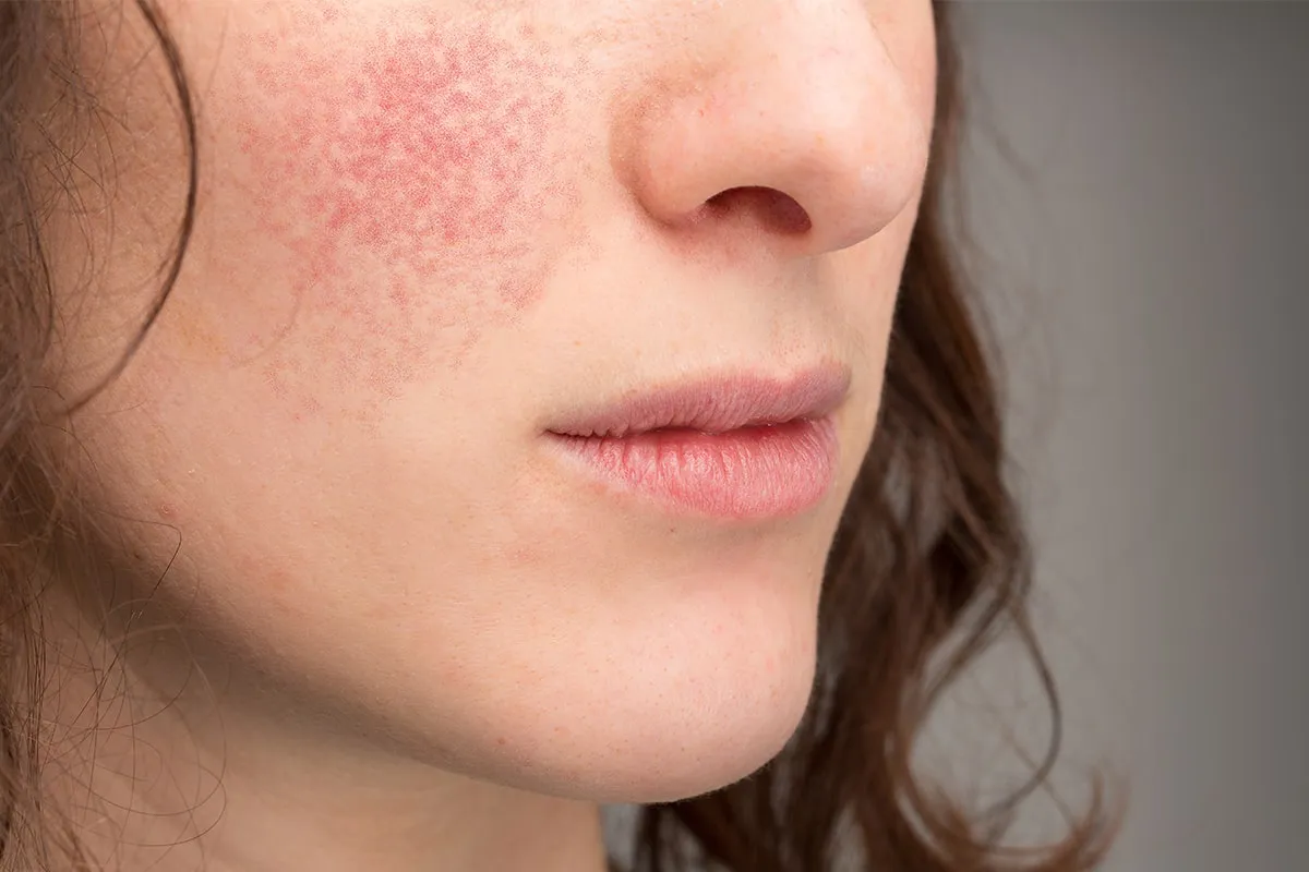 piel-atopica-dermatitis