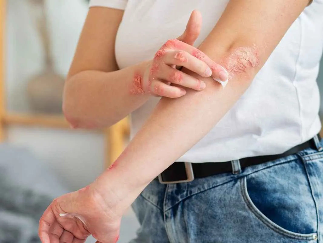 psoriasis