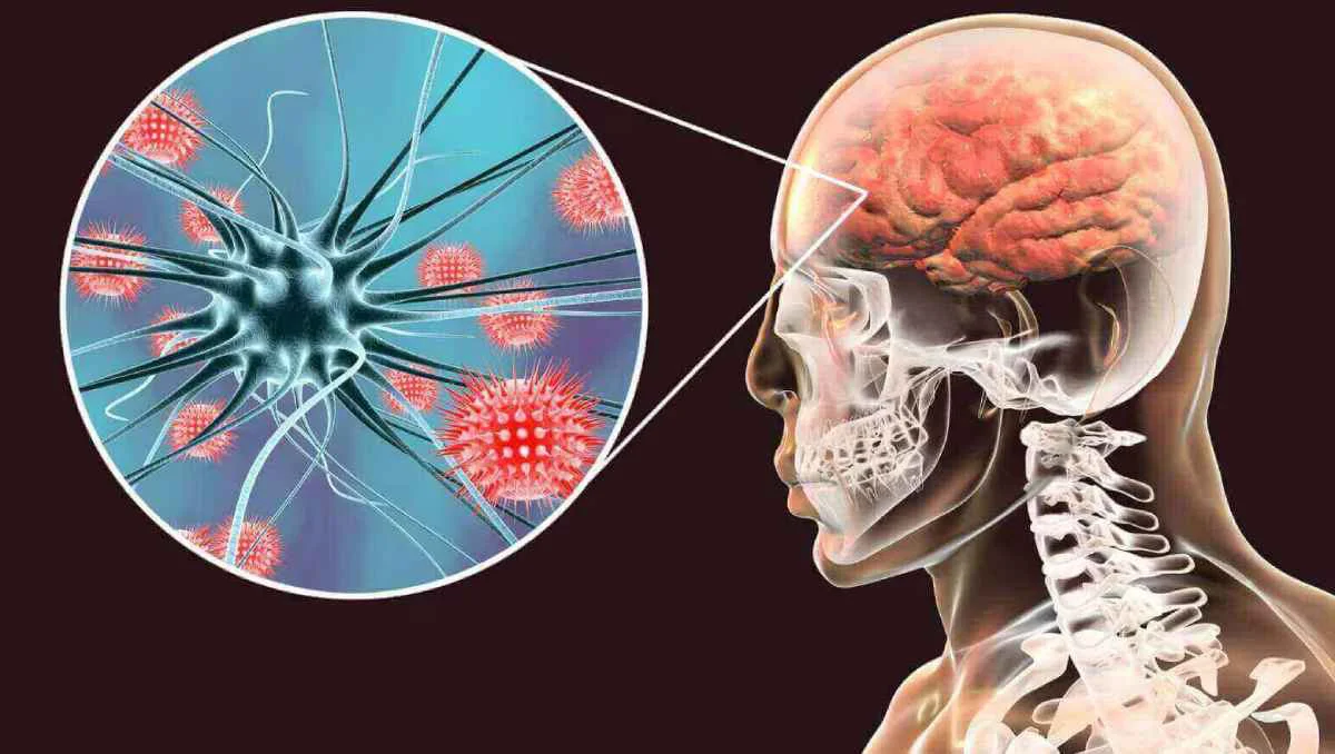 meningitis